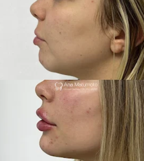 Antes e depois — preenchimento de mento